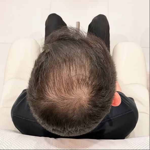 治療開始時